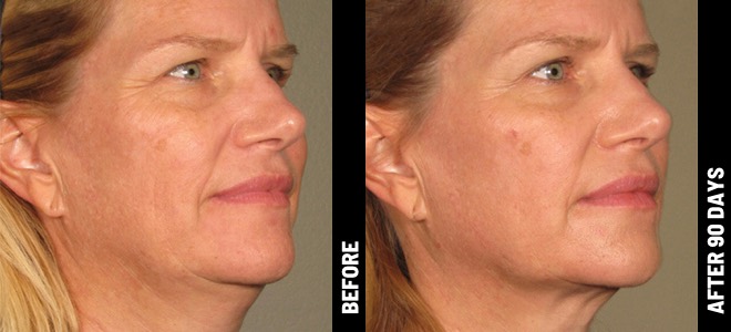 Ultherapy Before & After