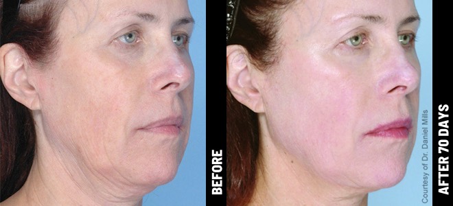 Ultherapy Before & After