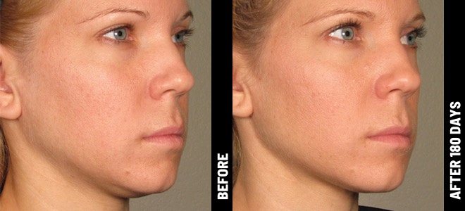 Ultherapy Before & After