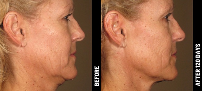 Ultherapy Before & After