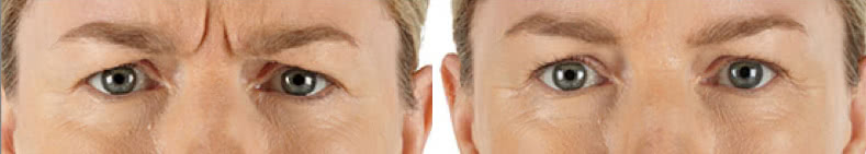 Xeomin Before & After