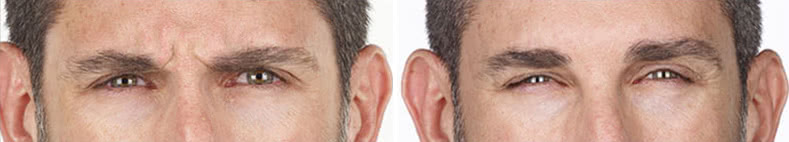 Xeomin Before & After