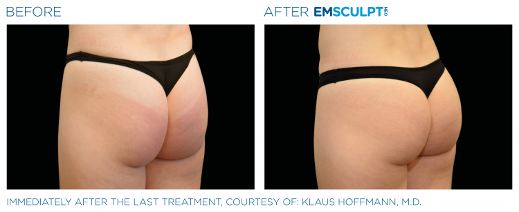 Before & After EMSCULPT NEO