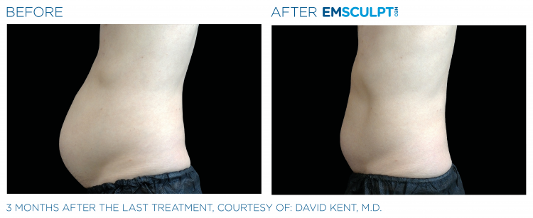 Before & After EMSCULPT NEO
