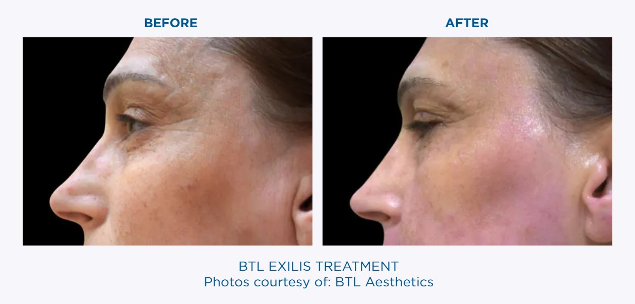 BTL EXILIS Before & After