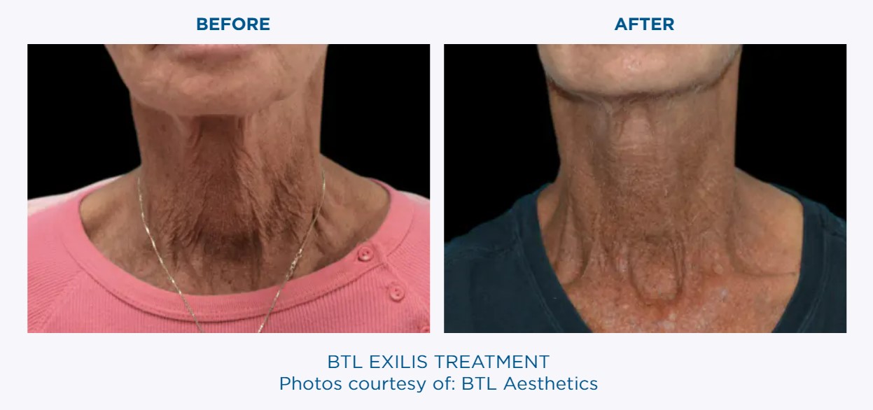 BTL EXILIS Before & After