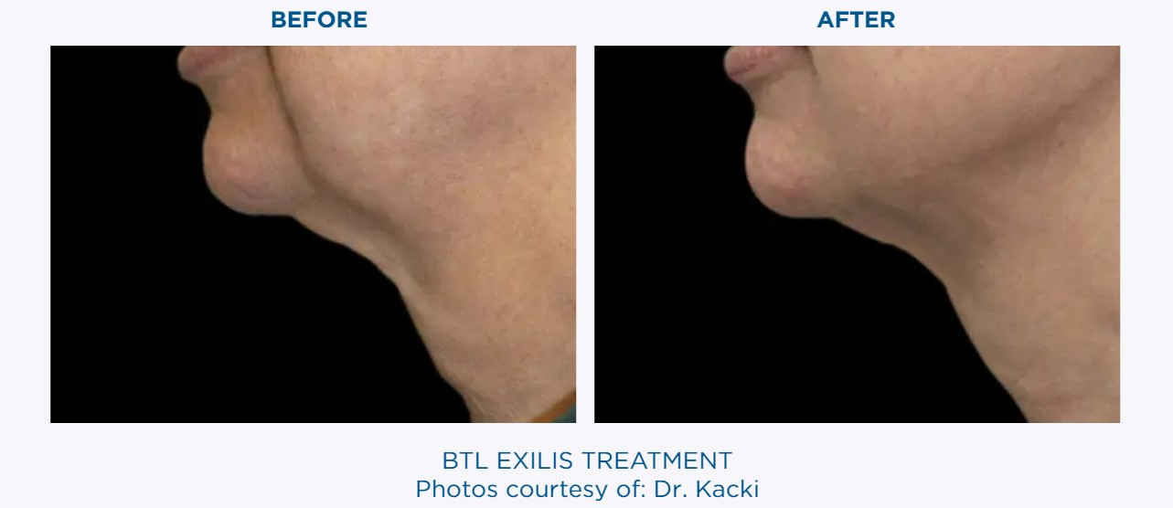 BTL EXILIS Before & After