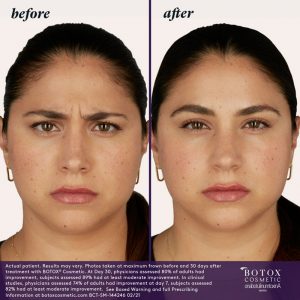 BOTOX Before & After
