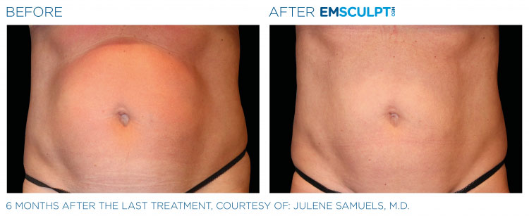 emsculpt-neo-ba-slider-2