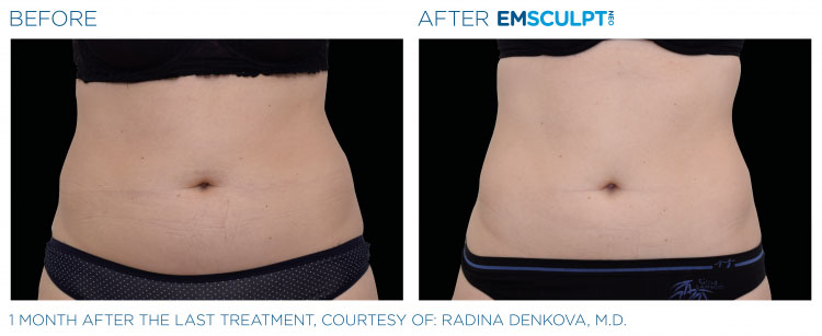 emsculpt-neo-ba-slider-3
