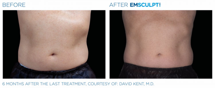 emsculpt-neo-ba-slider