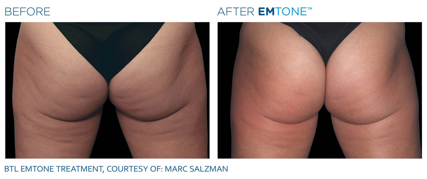 Before & After EMTONE