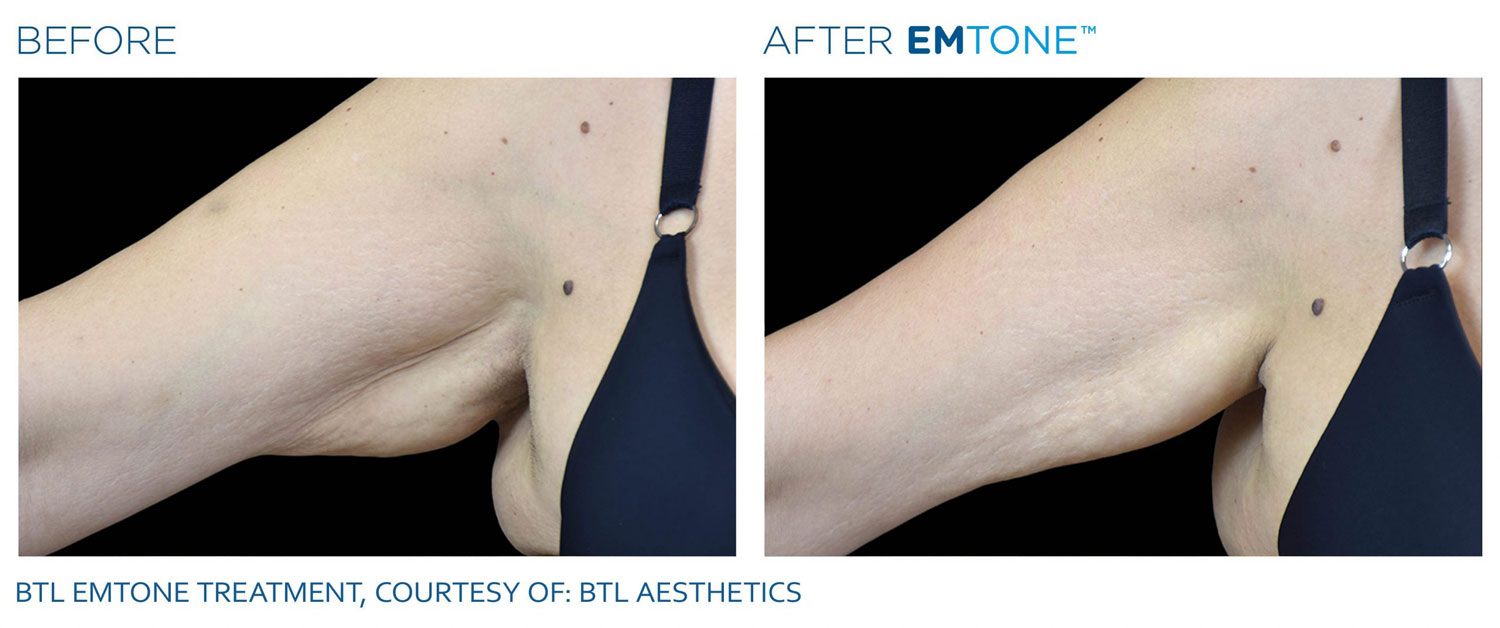 Before & After EMTONE