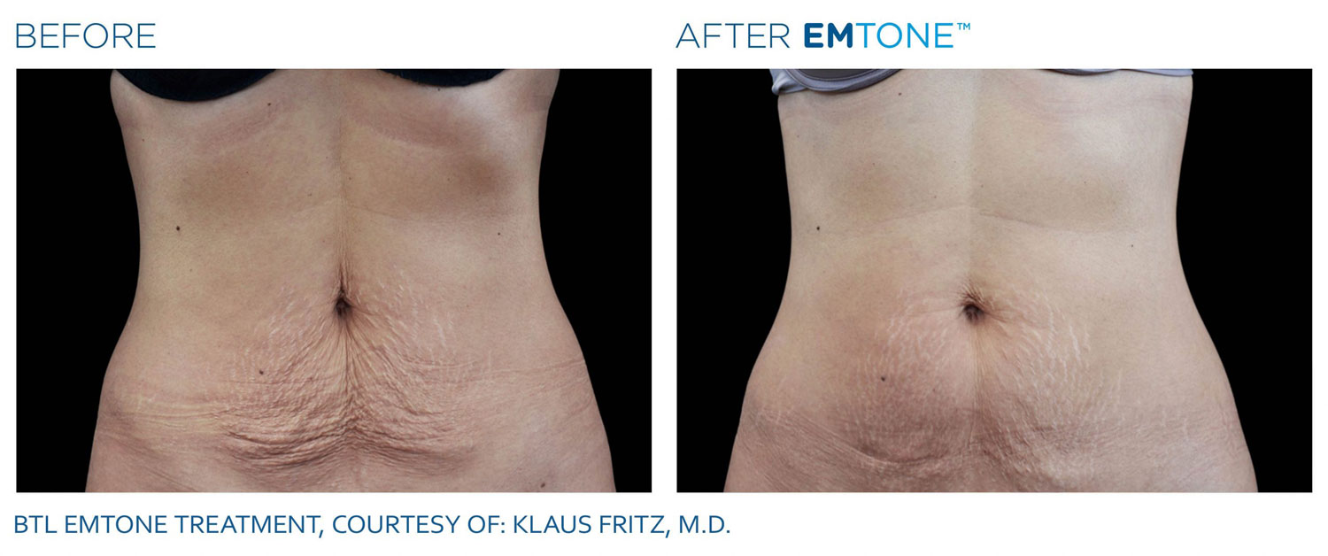 Before & After EMTONE