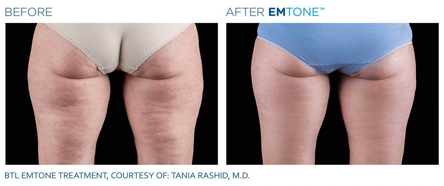 Before & After EMTONE
