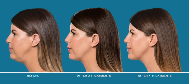 Kybella Before & After | Injectables