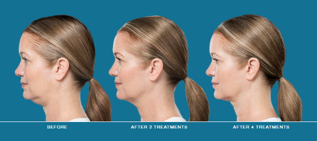 Kybella Before & After | Injectables