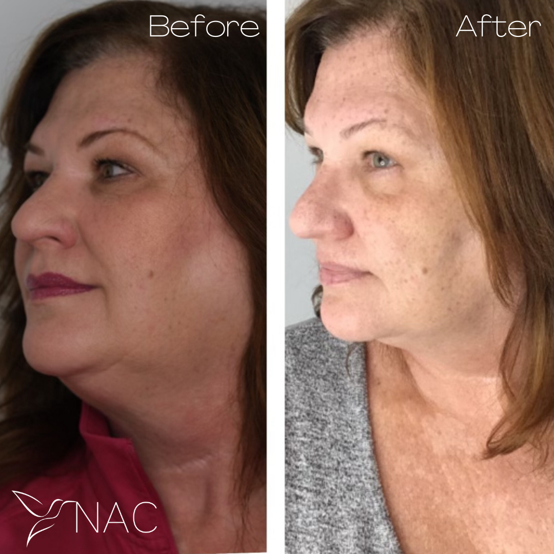 kybella before and after