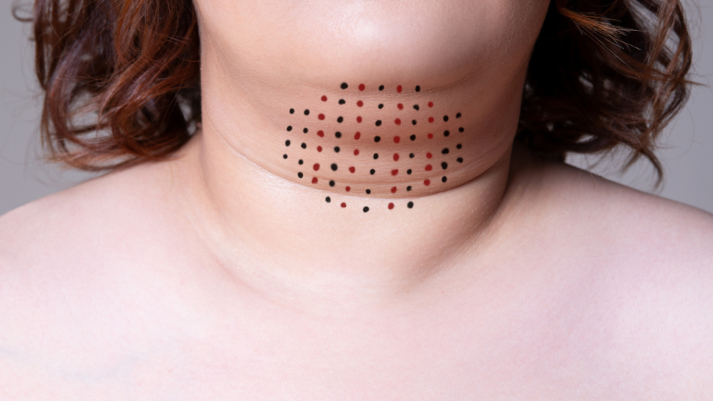 chin with kybella dots