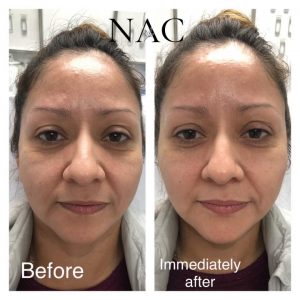 Before & After Cheek Lift | Fillers
