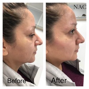 Before & After Cheek Lift | Fillers