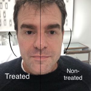 NACMD Lip filler