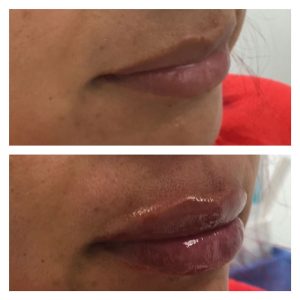 Lip filler