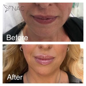 Lip filler