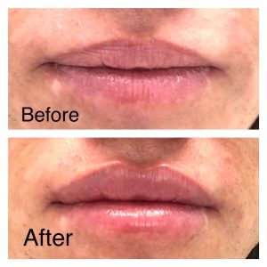 Lip filler