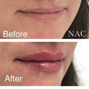 Lip filler