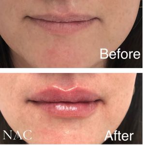 Lip filler
