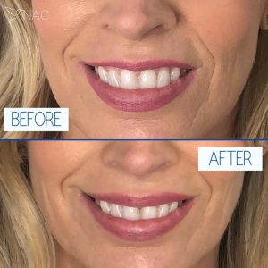 Lip filler