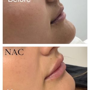 Lip filler