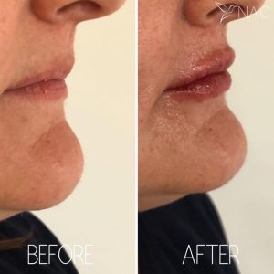 Lip filler