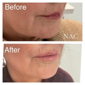 Lip filler