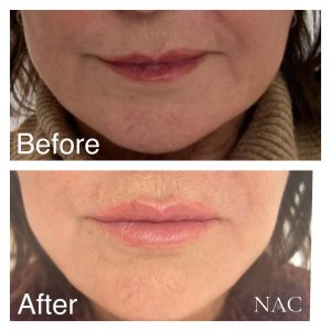 Lip filler
