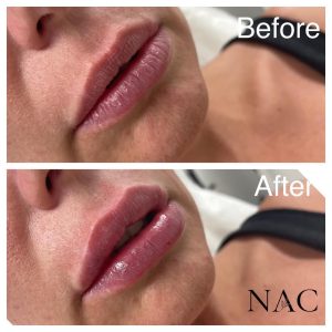 Lip filler