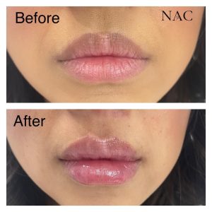 Lip filler