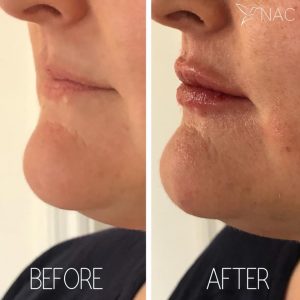 Lip filler