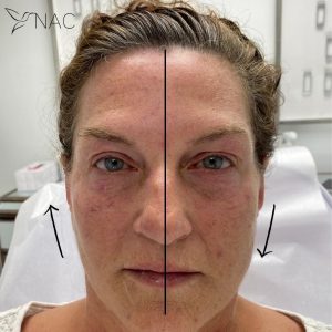 Before & After Cheek Lift | Fillers