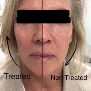Before & After Cheek Lift | Fillers