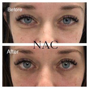 Before & After Tear Through | Fillers