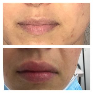 Before & After Lips | Fillers