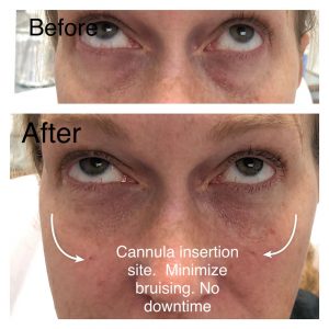 Before & After Tear Through | Fillers