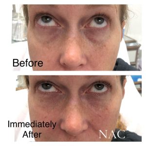 Before & After Tear Through | Fillers