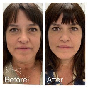 Before & After Cheek Lift | Fillers