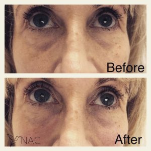 Before & After Tear Through | Fillers